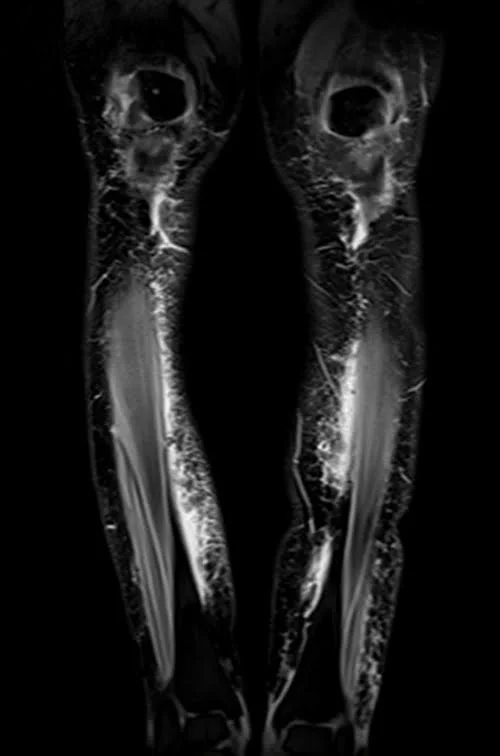 mri lower legs (calves) stir coronal image 1 - MRI