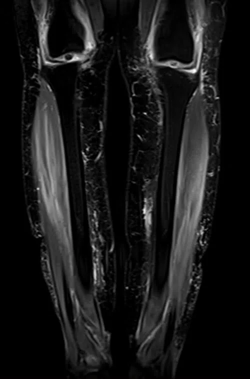 mri lower legs (calves) stir coronal image 2 - MRI