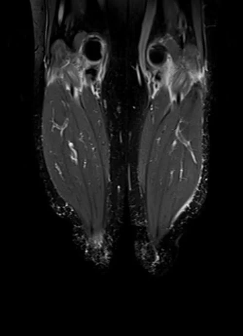 mri lower legs (calves) stir coronal image 3 - MRI