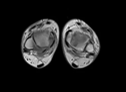mri lower legs (calves) t1 axial image 1 - MRI