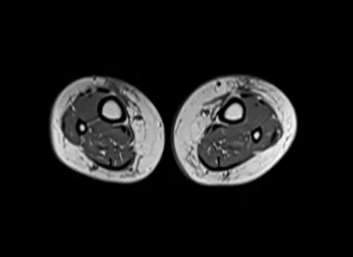 mri lower legs (calves) t1 axial image 2 - MRI