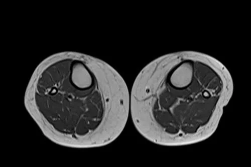 mri lower legs (calves) t1 axial image 3 - MRI