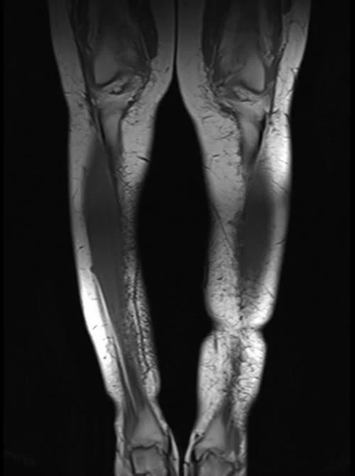 mri lower legs (calves) t1 coronal image 1 - MRI