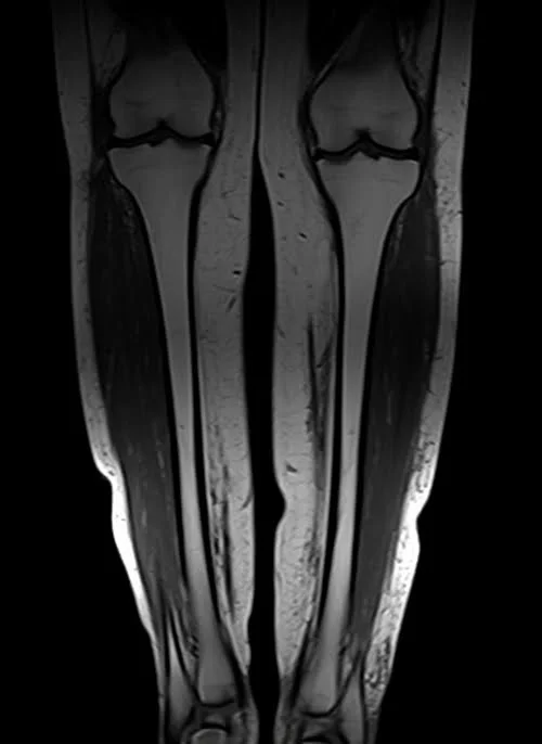 mri lower legs (calves) t1 coronal image 2 - MRI