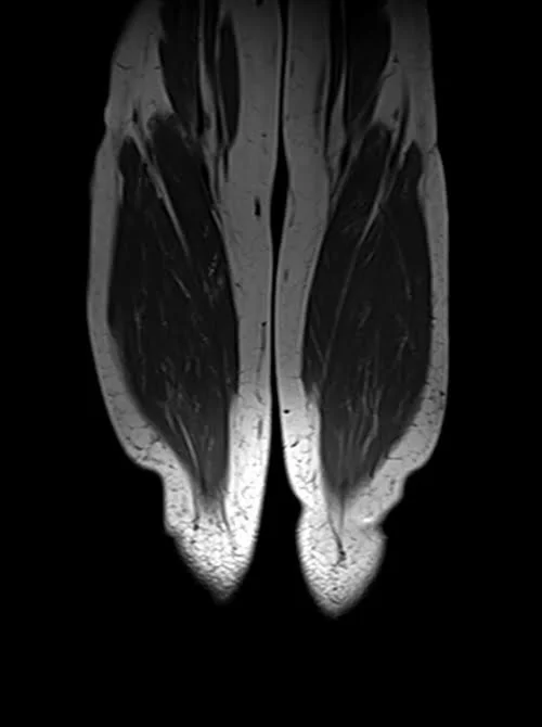 mri lower legs (calves) t1 coronal image 3 - MRI