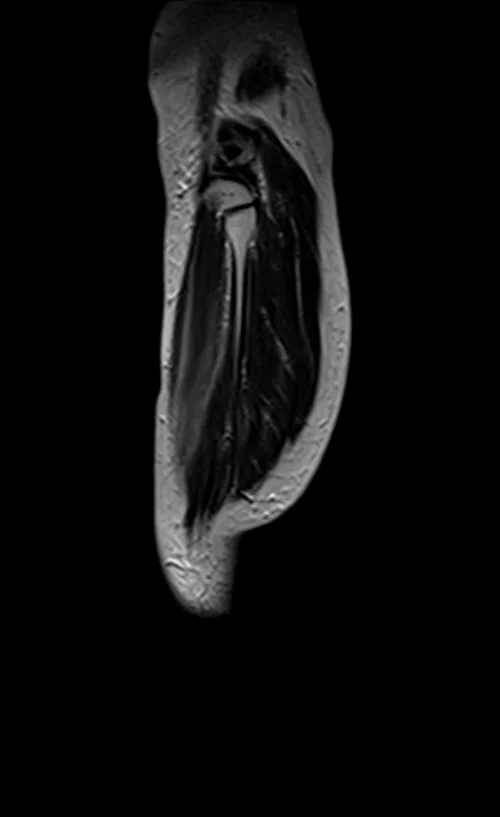 mri lower legs (calves) t2 sagittal image 3 - MRI
