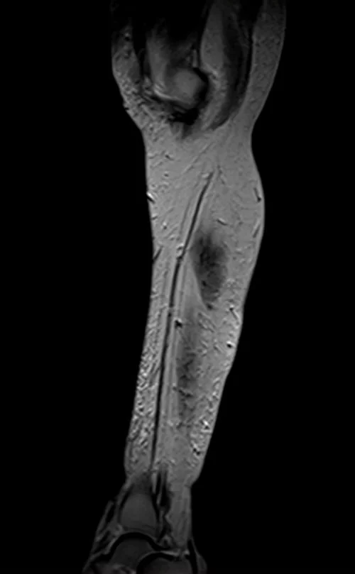mri lower legs (calves) t2 sagittall image 1 - MRI