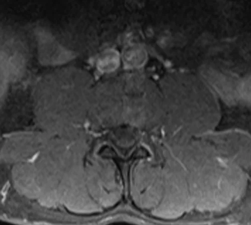 mri lumbar spine post contrast axial image 4 - MRI