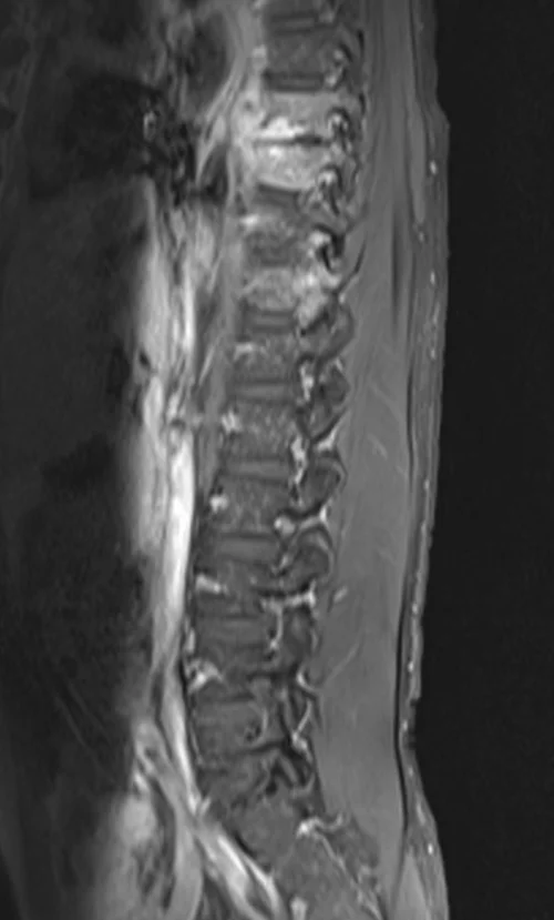 mri lumbar spine post contrast sagittal mage 1 - MRI