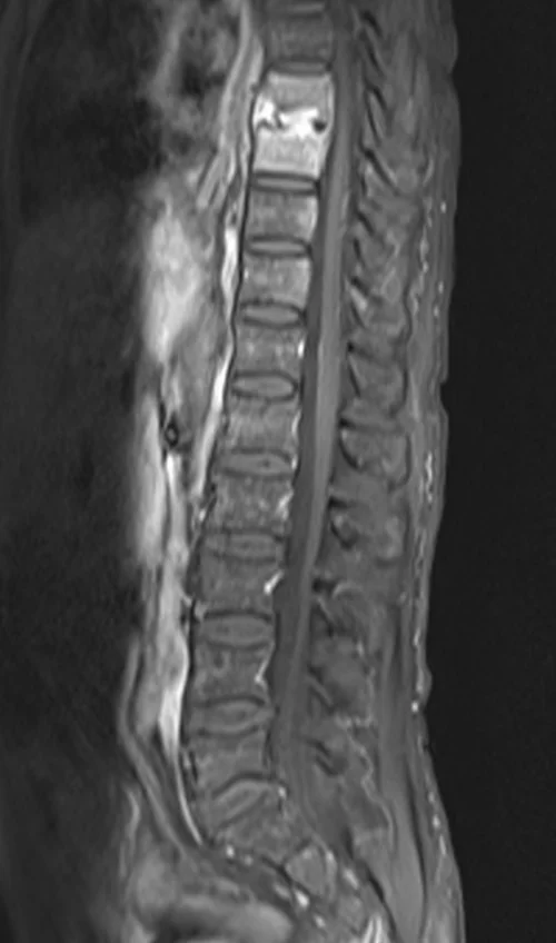 mri lumbar spine post contrast sagittal mage 2 - MRI