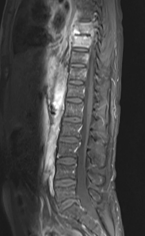 mri lumbar spine post contrast sagittal mage 3 - MRI