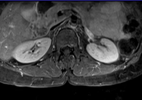 mri lumbosacral plexus axial t1 fat sat post contrast image 1 - MRI