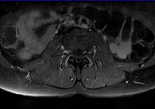 mri lumbosacral plexus axial t1 fat sat post contrast image 2 - MRI