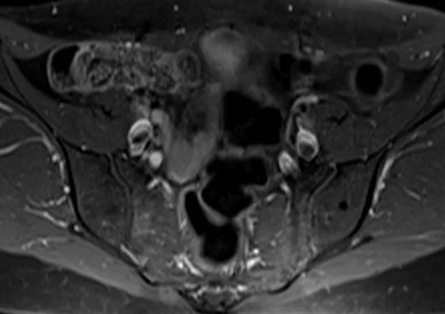 mri lumbosacral plexus axial t1 fat sat post contrast image 4 - MRI