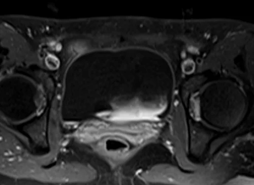 mri lumbosacral plexus axial t1 fat sat post contrast image 5 - MRI