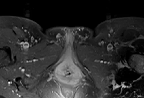 mri lumbosacral plexus axial t1 fat sat post contrast image 6 - MRI