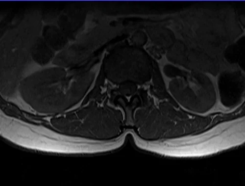 mri lumbosacral plexus axial t1 image 1 - MRI