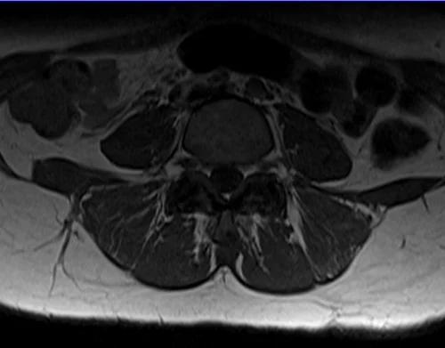 mri lumbosacral plexus axial t1 image 2 - MRI