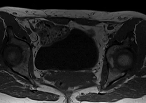 mri lumbosacral plexus axial t1 image 5 - MRI