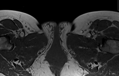 mri lumbosacral plexus axial t1 image 6 - MRI