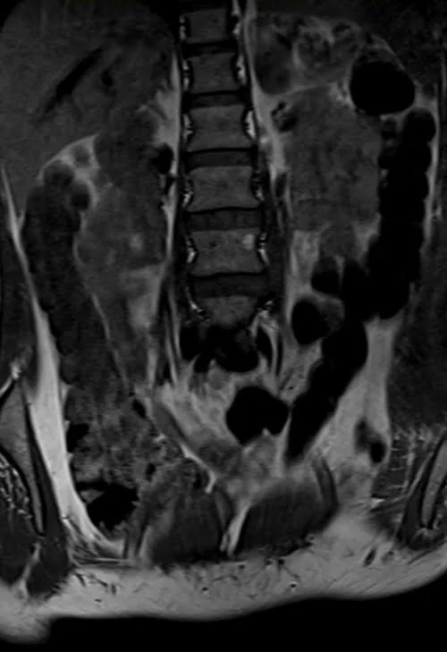 mri lumbosacral plexus coronal t1 image 1 - MRI
