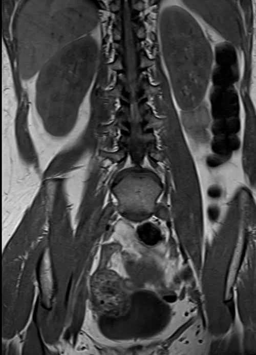 mri lumbosacral plexus coronal t1 image 3 - MRI