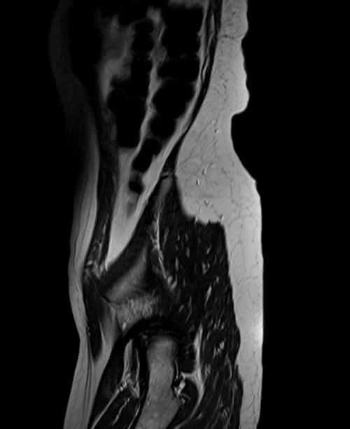 mri lumbosacral plexus sagittal t2 image 1 - MRI