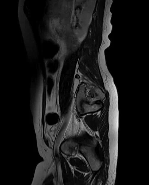 mri lumbosacral plexus sagittal t2 image 2 - MRI