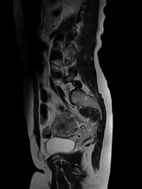 mri lumbosacral plexus sagittal t2 image 3 - MRI