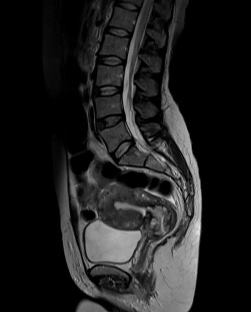 mri lumbosacral plexus sagittal t2 image 4 - MRI