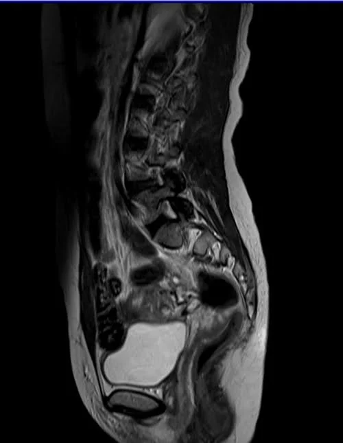 mri lumbosacral plexus sagittal t2 image 5 - MRI