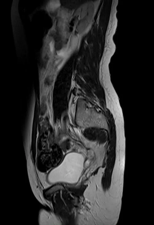 mri lumbosacral plexus sagittal t2 image 6 - MRI