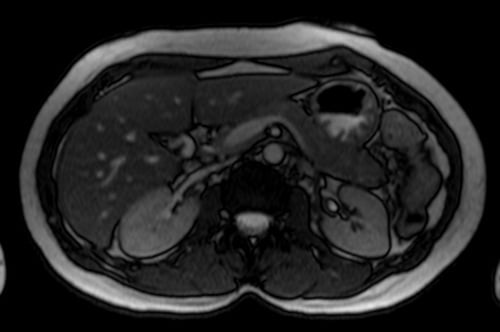 PLAN SECRETIN MRCP loc - mrimaster