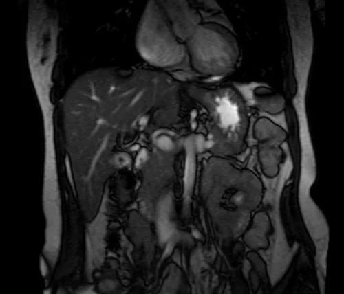 mri pancreas loc 2 - MRI