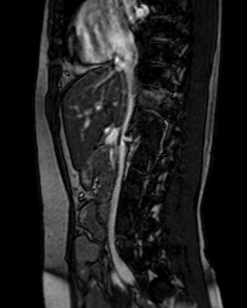 mri pancreas loc 3 - MRI
