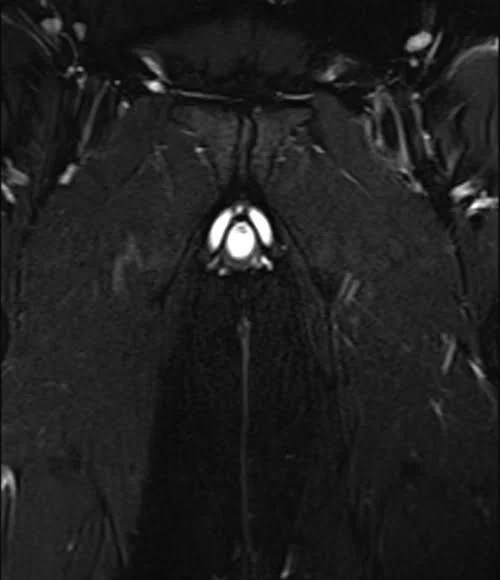 mri pelvis fistula coronal oblique stir image 1 - MRI