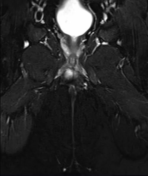 mri pelvis fistula coronal oblique stir image 2 - MRI