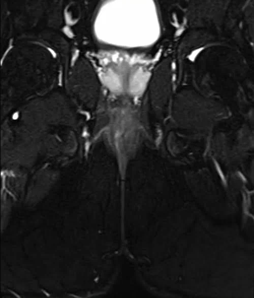 mri pelvis fistula coronal oblique stir image 3 - MRI