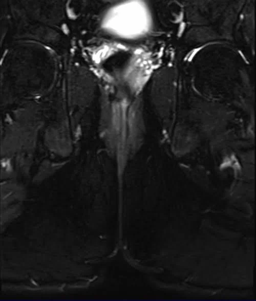 mri pelvis fistula coronal oblique stir image 4 - MRI