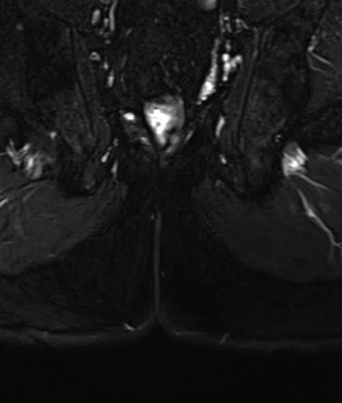 mri pelvis fistula coronal oblique stir image 5 - MRI