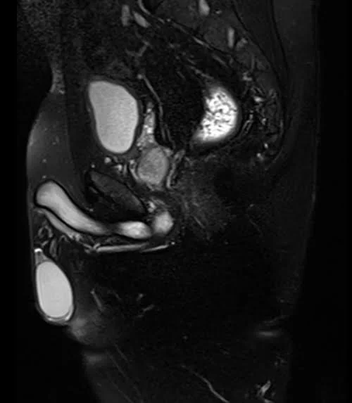 mri pelvis fistula sagittal stir image 1 - MRI