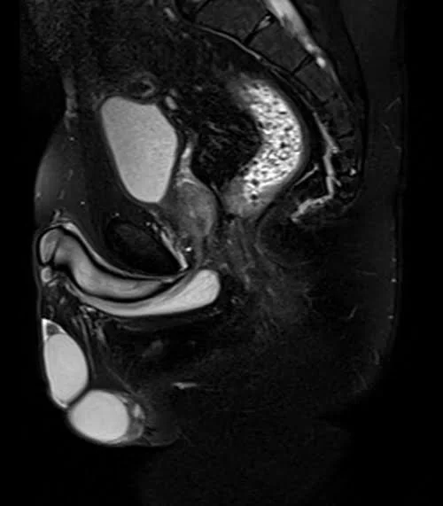 mri pelvis fistula sagittal stir image 2 - MRI