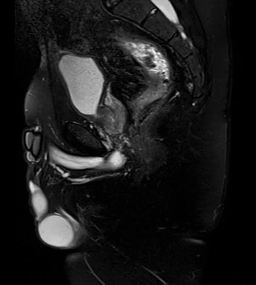 mri pelvis fistula sagittal stir image 3 - MRI