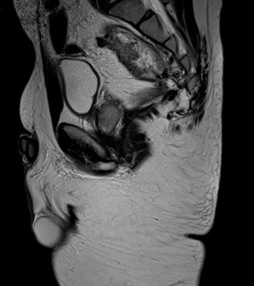 mri pelvis fistula sagittal t2 image 1 - MRI
