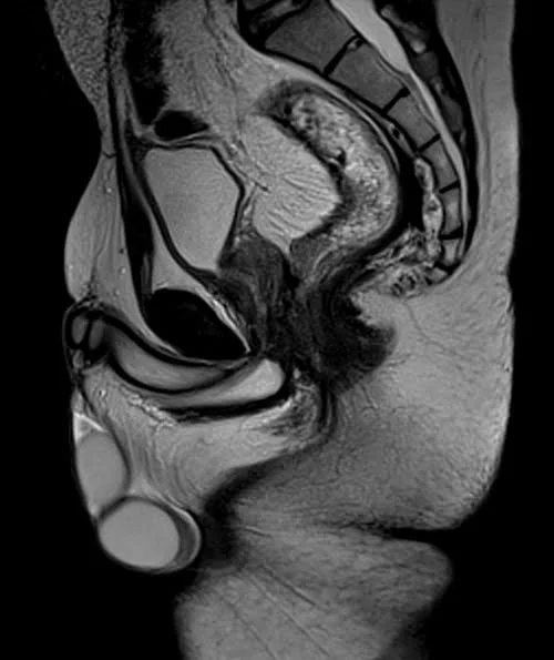 mri pelvis fistula sagittal t2 image 2 - MRI