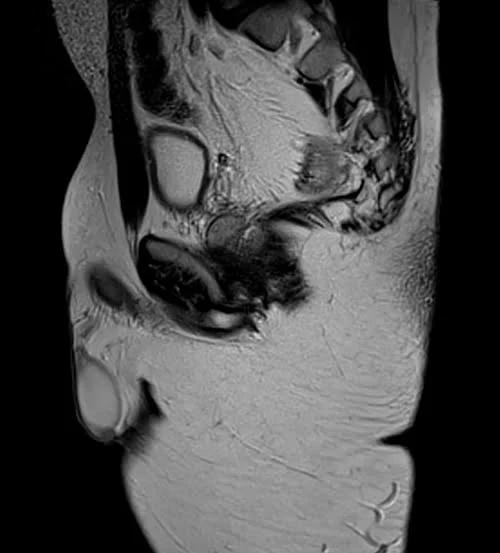 mri pelvis fistula sagittal t2 image 3 - MRI