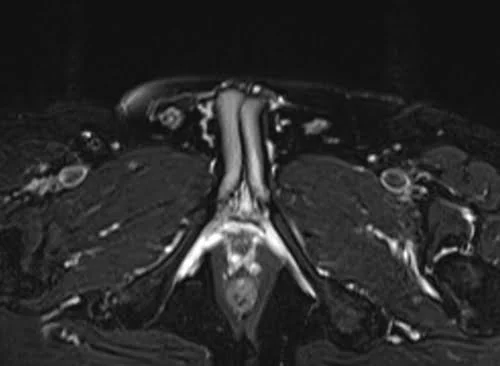 mri penis axial stir image 1 - MRI