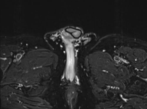 mri penis axial stir image 2 - MRI