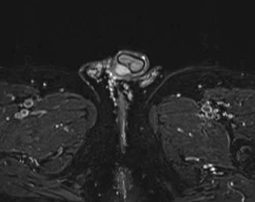 mri penis axial stir image 3 - MRI