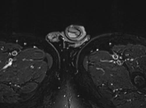 mri penis axial stir image 4 - MRI